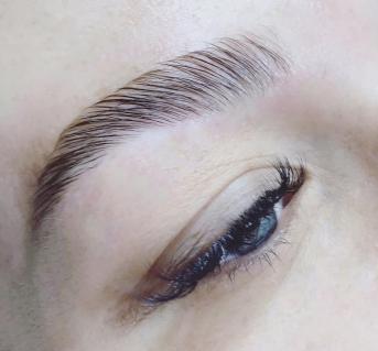 Brow lift